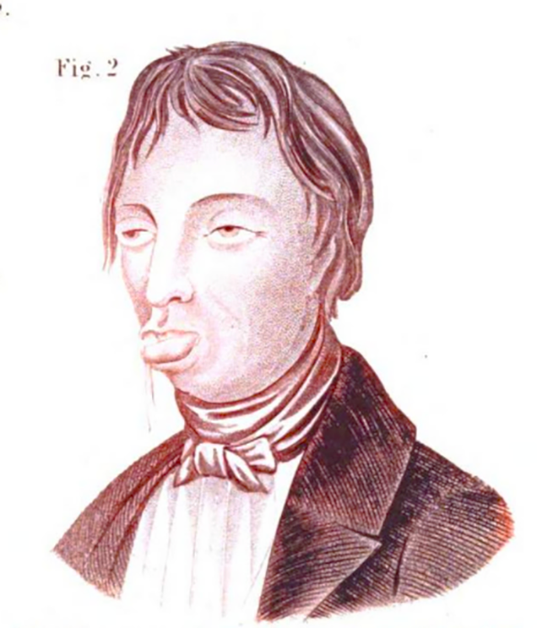 Drawing of a "habitual masturbator," from the 1847 book <em>The Silent Friend</em>.