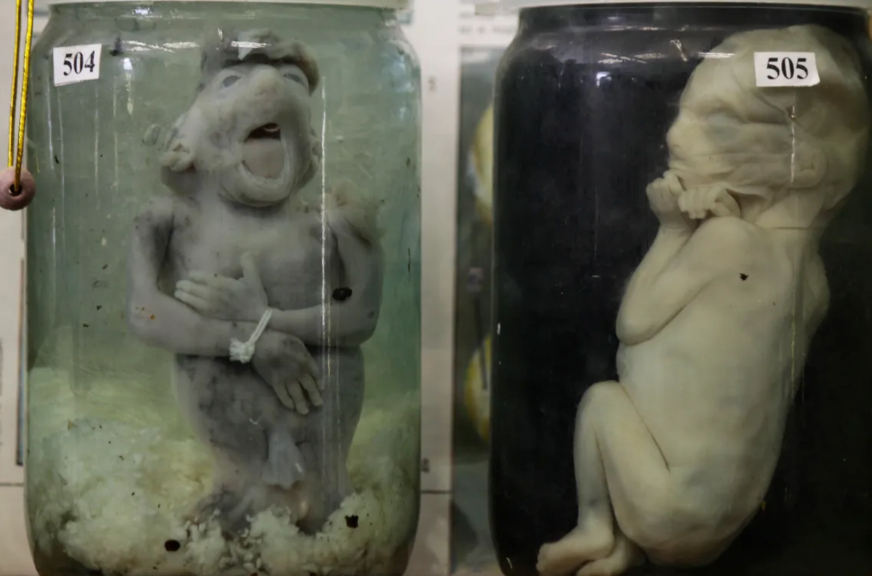 These preserved fetuses have severe genetic and developmental anomalies, supposedly from the mothers’ alcohol consumption.