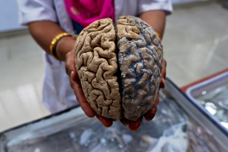 A formalin-fixed human brain.