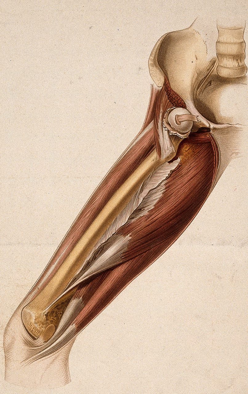 An engraving of a thigh with a dislocated femur by Debray after Bion, ca. 1870. 