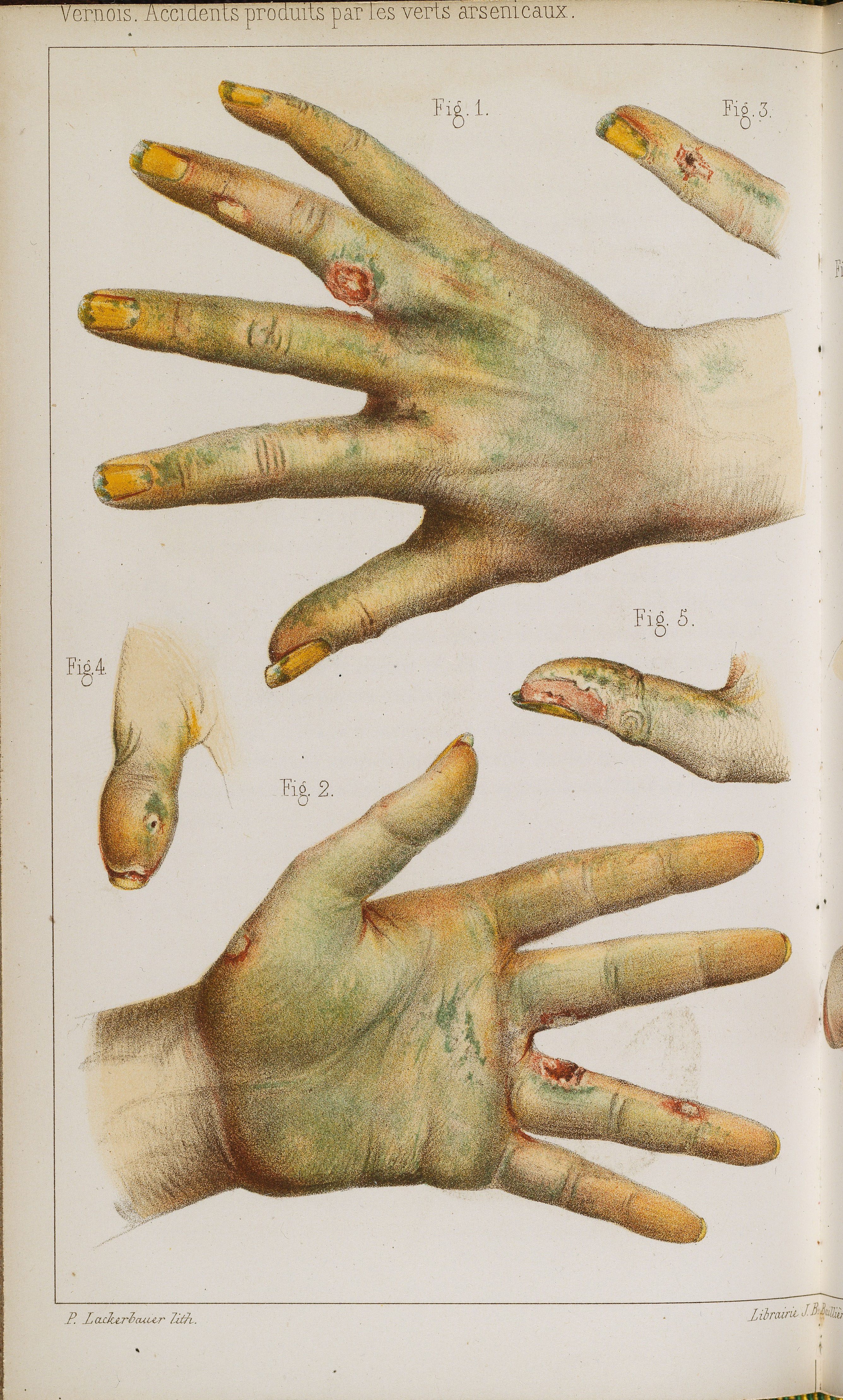 Chromolithograph showing the effect of arsenic used in artificial flowermaking on workers’ hands, 1859.