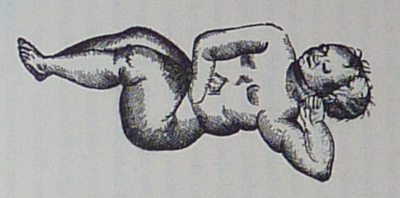 An illustration of the lithopedion of Sens.