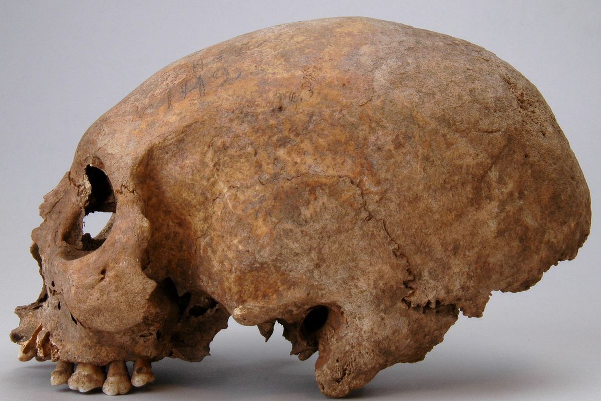 People are able to reshape skulls using bandages on infant heads.