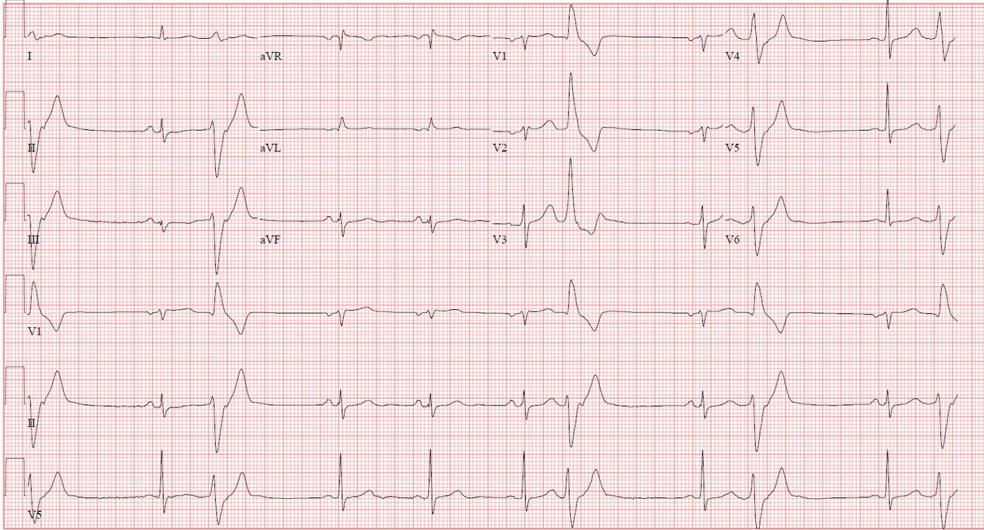 A 12-lead electrocardiogram showing multiple premature ventricular contractions. 