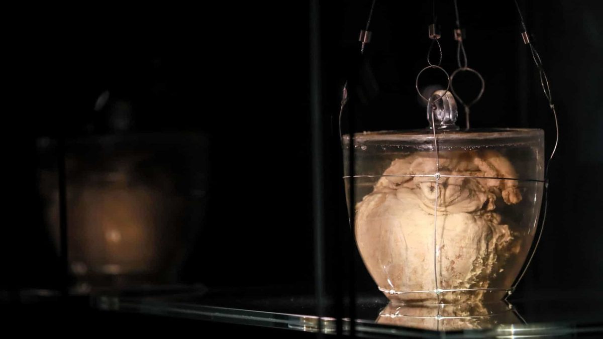 It is believed that Dom Pedro's heart is enlarged because he died of tuberculosis, which can cause organs to swell. But the Brotherhood of Our Lady of Lapa has refused to allow scientists to biopsy the heart because of the damage the procedure could cause.