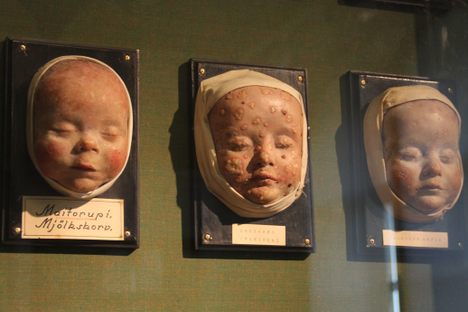 Infant Wax Moulage