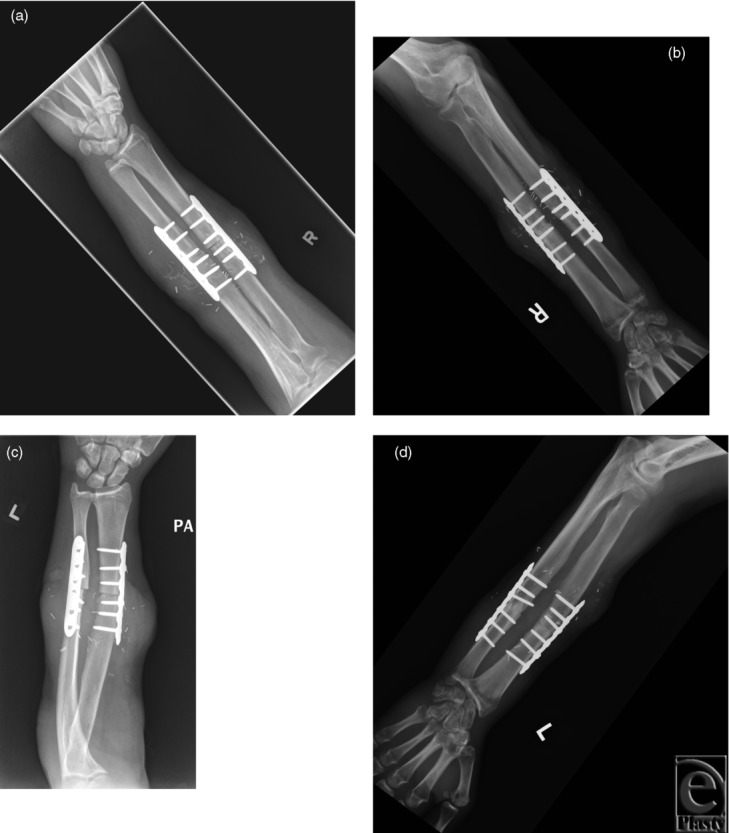 Radiography of the right and left arm after hand transplant
