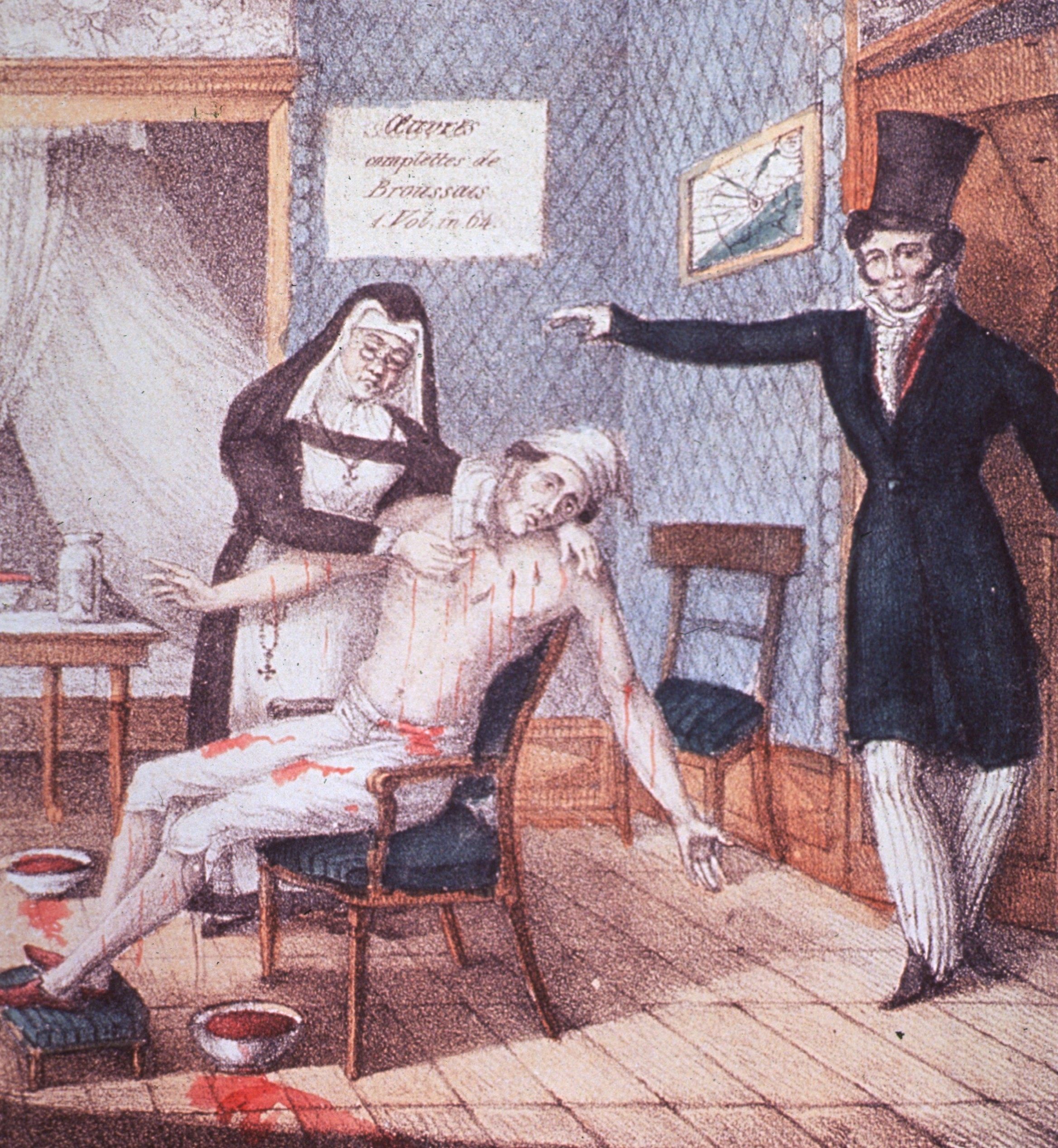 An illustration depicting a leeching procedure overseen by François-Joseph-Victor Broussais, a French physician dedicated to bloodletting.
