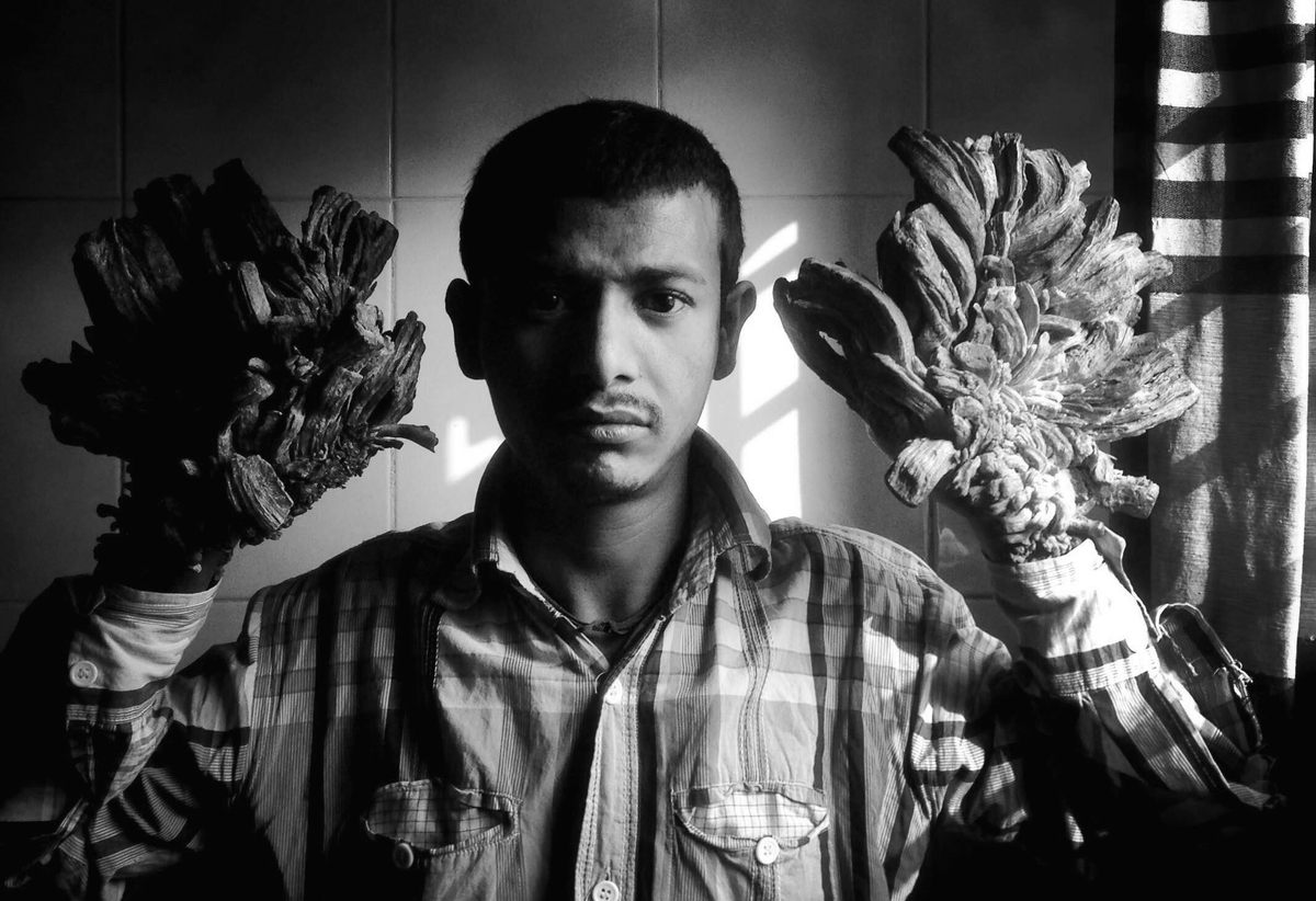 'Tree Man' Is No Longer 'Tree Man'