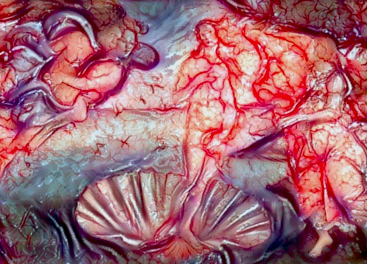 <em>Botticelli's Cerebral Cortex Of A Patient With Epilepsy During Surgery</em>.