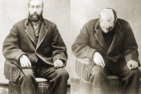 William Thompson Scalped Head