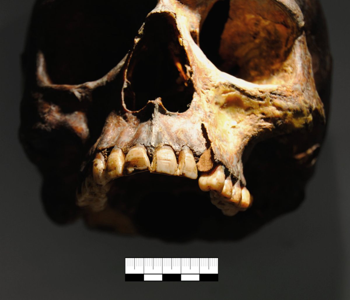 Filing lines onto teeth is well-known when it comes to Vikings, but skull modification is new.
