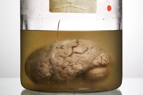 A Lost Collection of Abnormal Brains Finally Gets a History