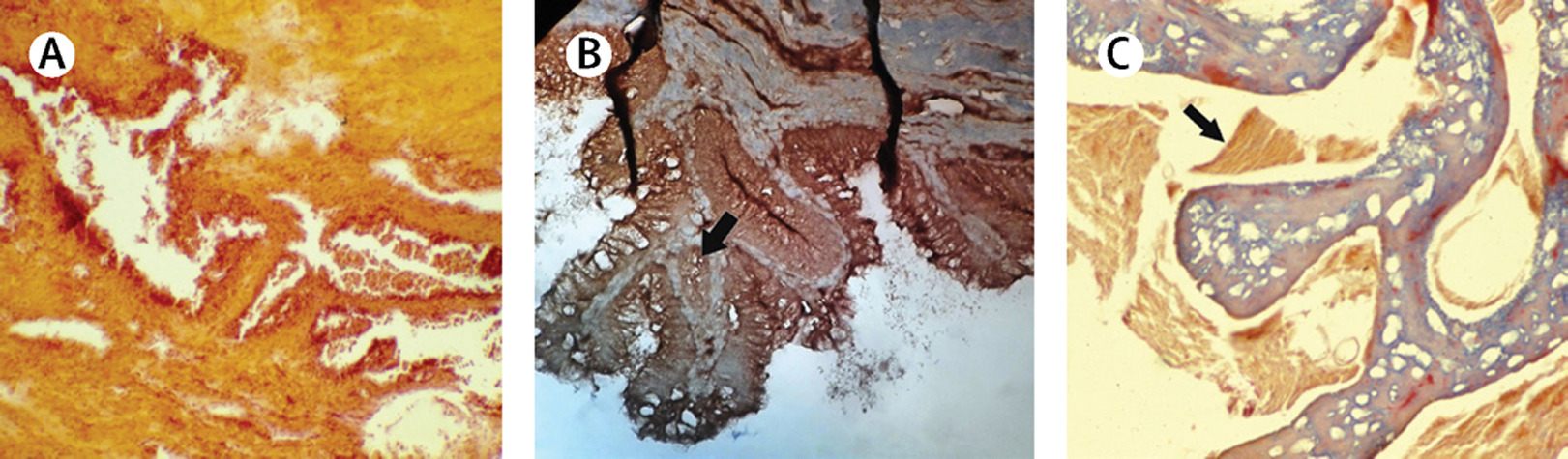 Micrographs of tumors from the mummified remains of members of the Aragonese court in Naples. 