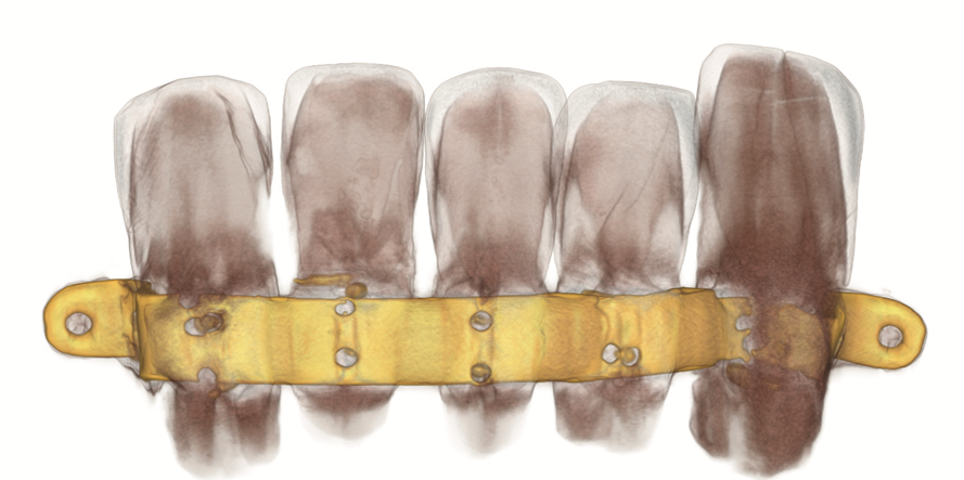 A scan of the teeth shows the bar more clearly.