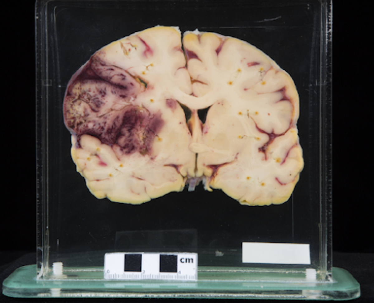 The impact of a stroke.