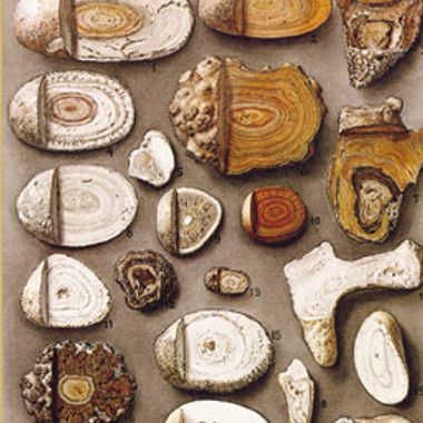 Gallstones