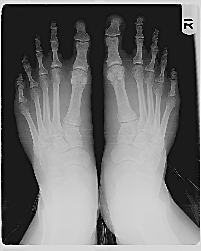 An x-ray showing Morton