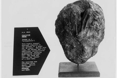 A lithopedion extracted 55 years after it formed.