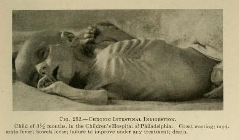 Chronic intestinal indigestion was another term for celiac.