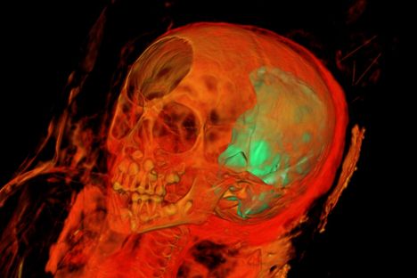 A CT scan of the mummy shows the child's skull, with milk teeth and adult teeth jostling for space. 