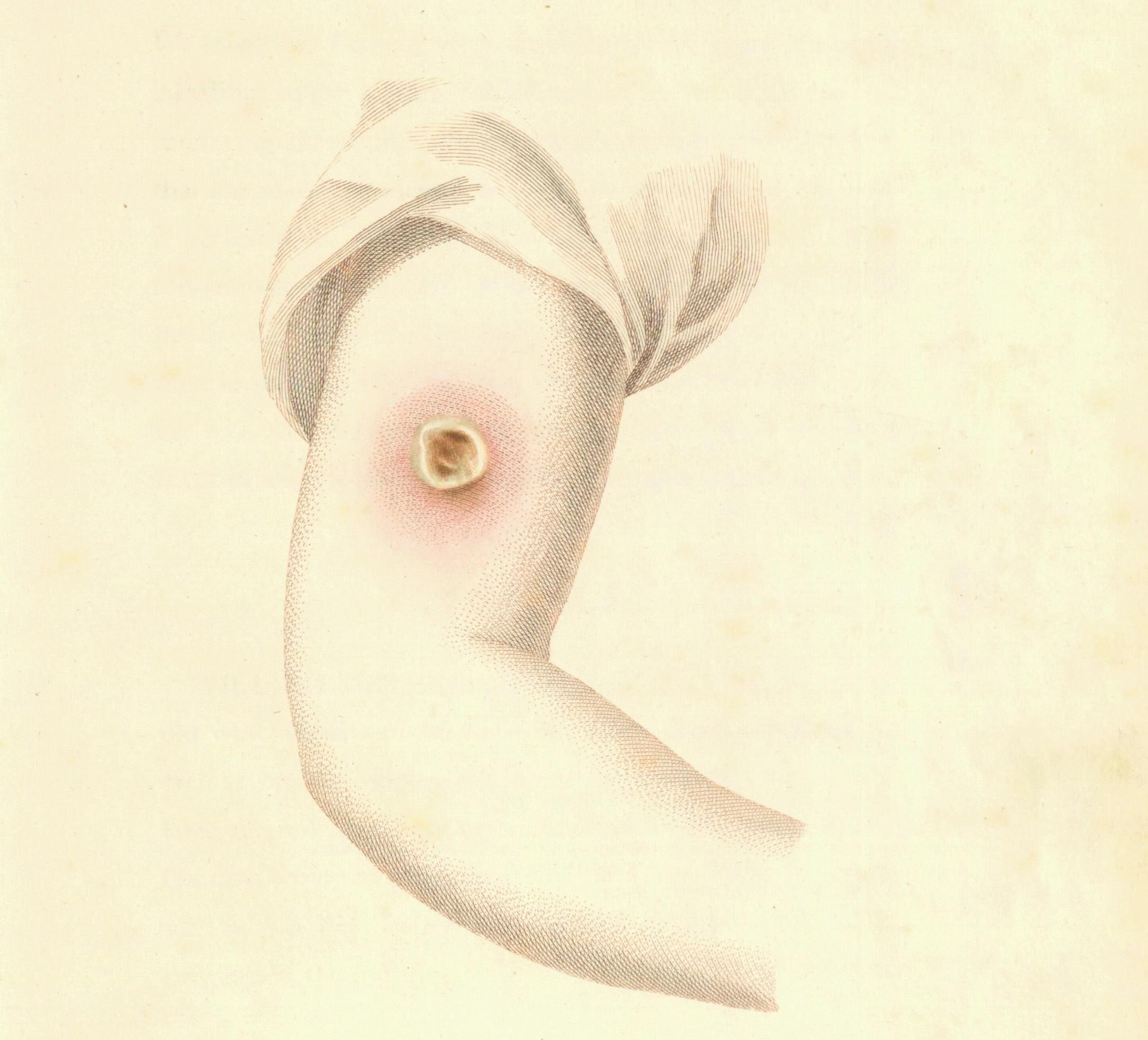 An illustration by Edward Jenner depicting the arm of a young vaccinated patient.