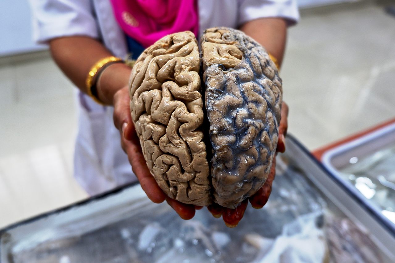 A formalin fixed human brain, ready to be handed to visitors.
