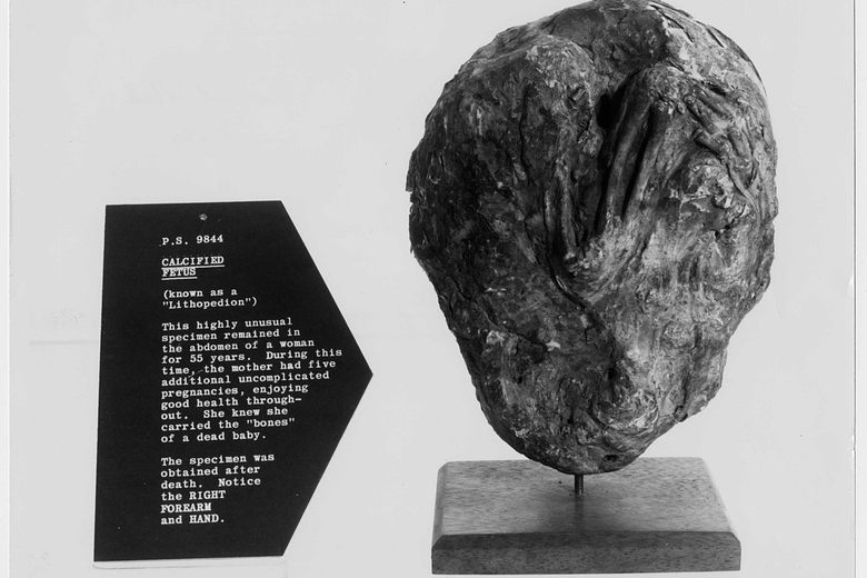A Fetus Can Turn to Stone in Its Mother